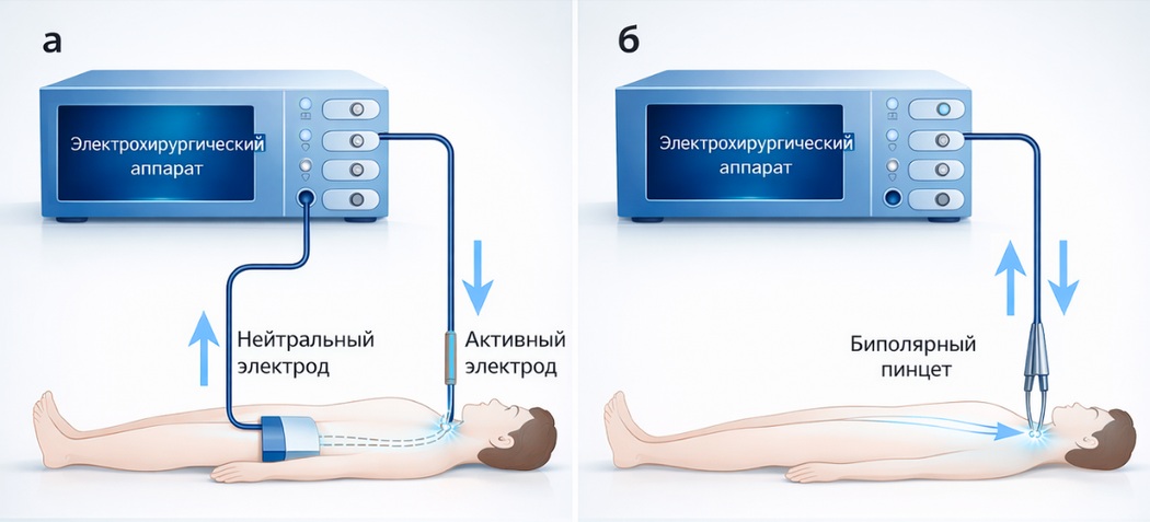 Схема монополярной и биполярной коагуляции в электрохирургии